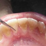способы удаления зубного камня