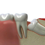 зубы, удаление