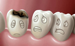 кариес, зубы, стоматолог