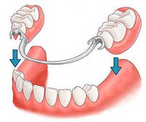 зубные протезы, стоматология